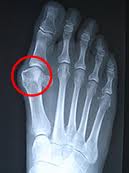bunion