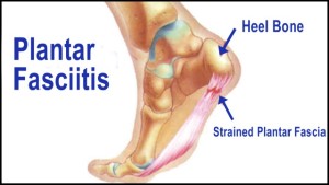 plantar fasciitis